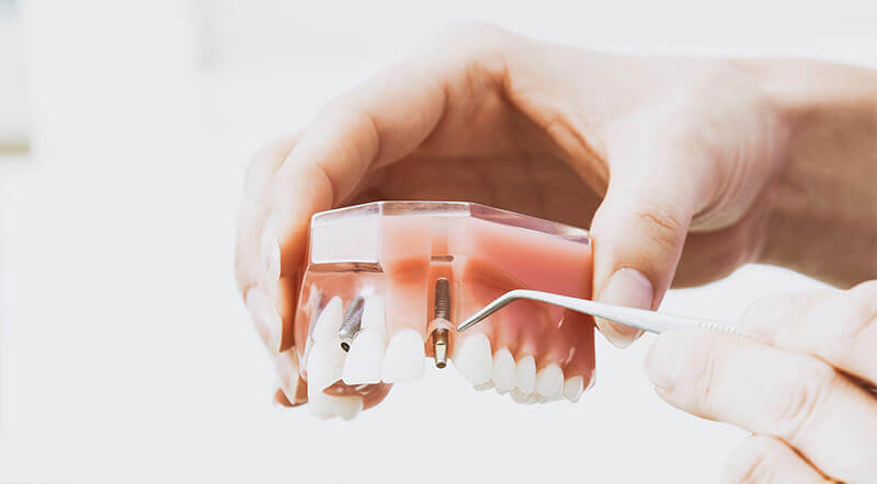 A set of dental implants.