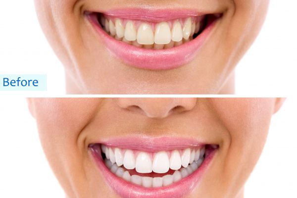A before and after of a woman with whitened teeth.