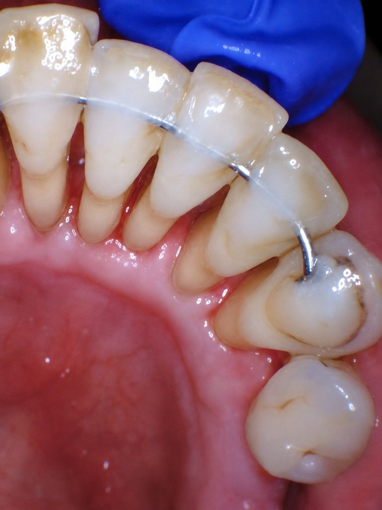 After treatment: Lower Anterior GBT Cleaning, Female Age: 64