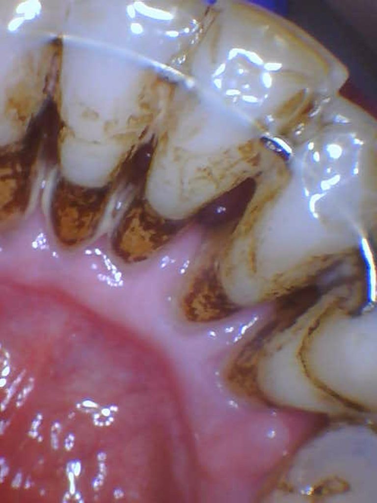 Before treatment: Lower Anterior GBT Cleaning, Female Age: 64