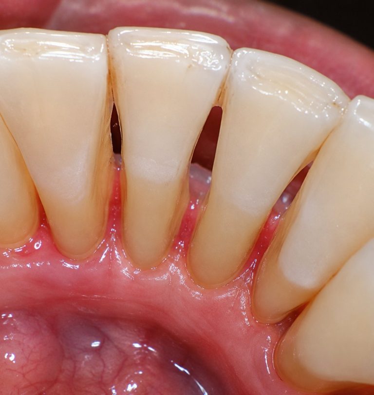 After treatment: Lower Anterior GBT Scaling, Male Age: 69