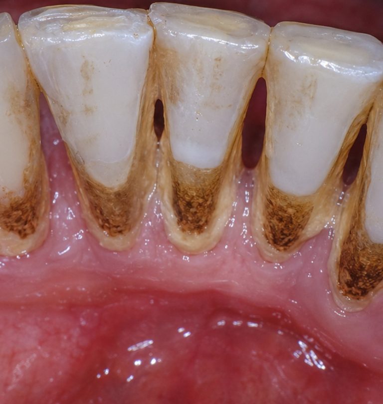 Before treatment: Lower Anterior GBT Scaling, Male Age: 69