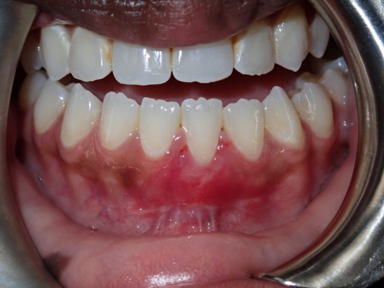 After treatment: Lower Anterior Connective Tissue Graft, Tooth 31, Age: 32