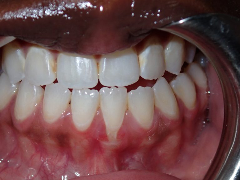 Before treatment: Lower Anterior Connective Tissue Graft, Tooth 31, Age: 32