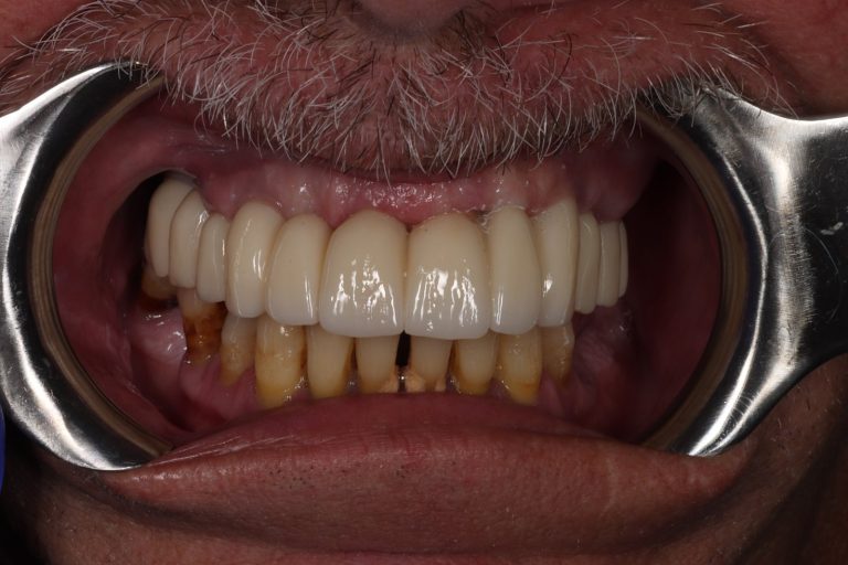 After treatment: Upper All-on-X, Male Age: 57