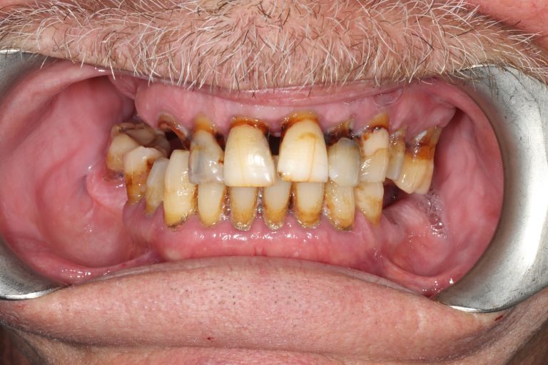 Before treatment: Upper All-on-X, Male Age: 57