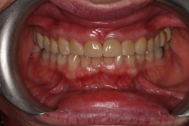 After treatment: Upper Full Mouth Rehabilitation, Female Age: 63