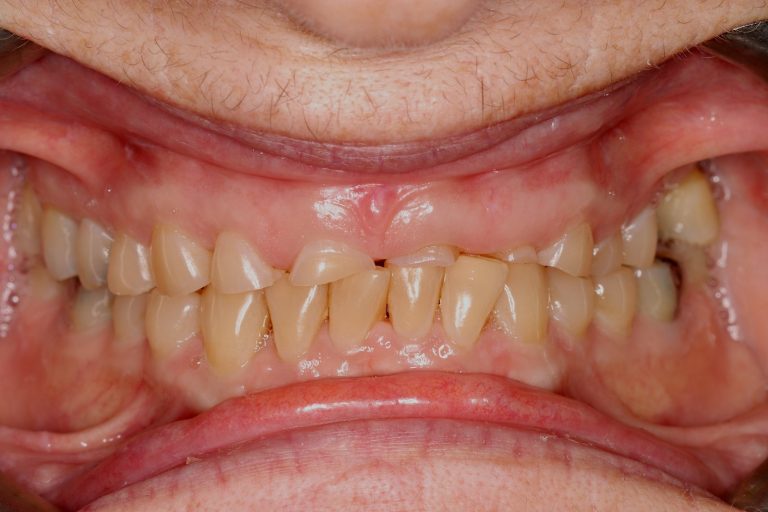 Before treatment: Upper Full Mouth Rehabilitation, Female Age: 63