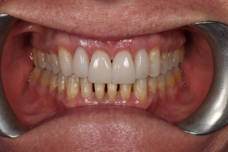 After treatment: Upper Front Teeth Veneers, Teeth 12-22, Female Age: 65