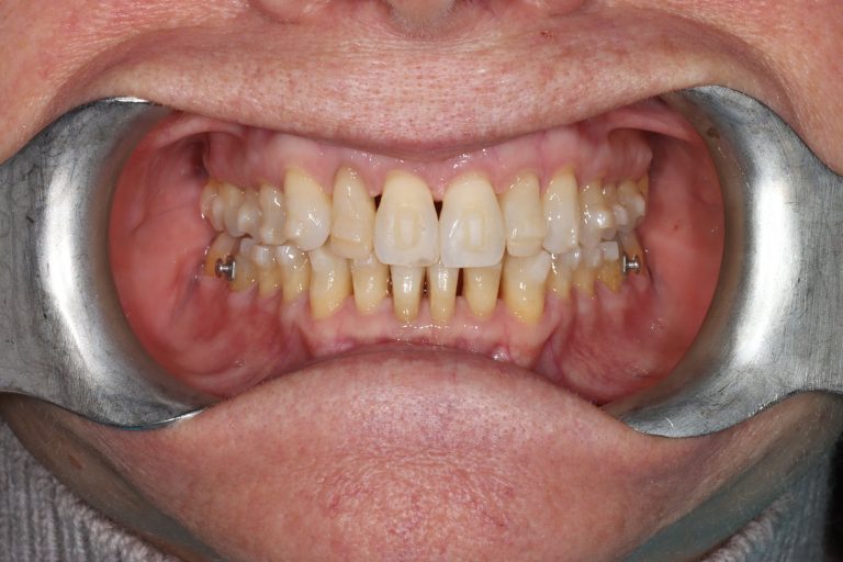 Before treatment: Upper Front Teeth Veneers, Teeth 12-22, Female Age: 65