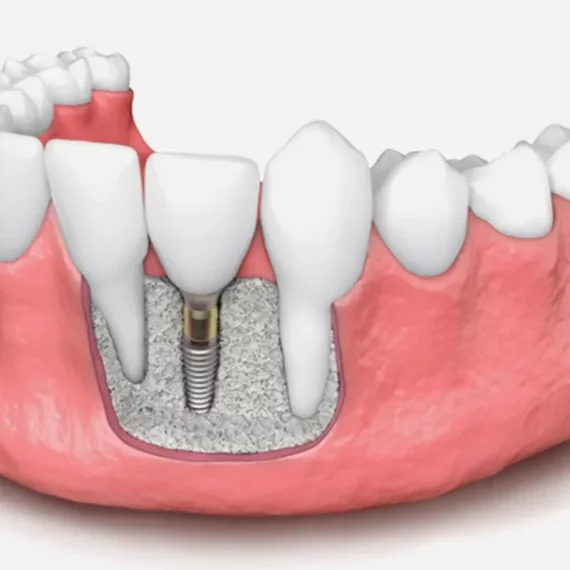 bone-graft